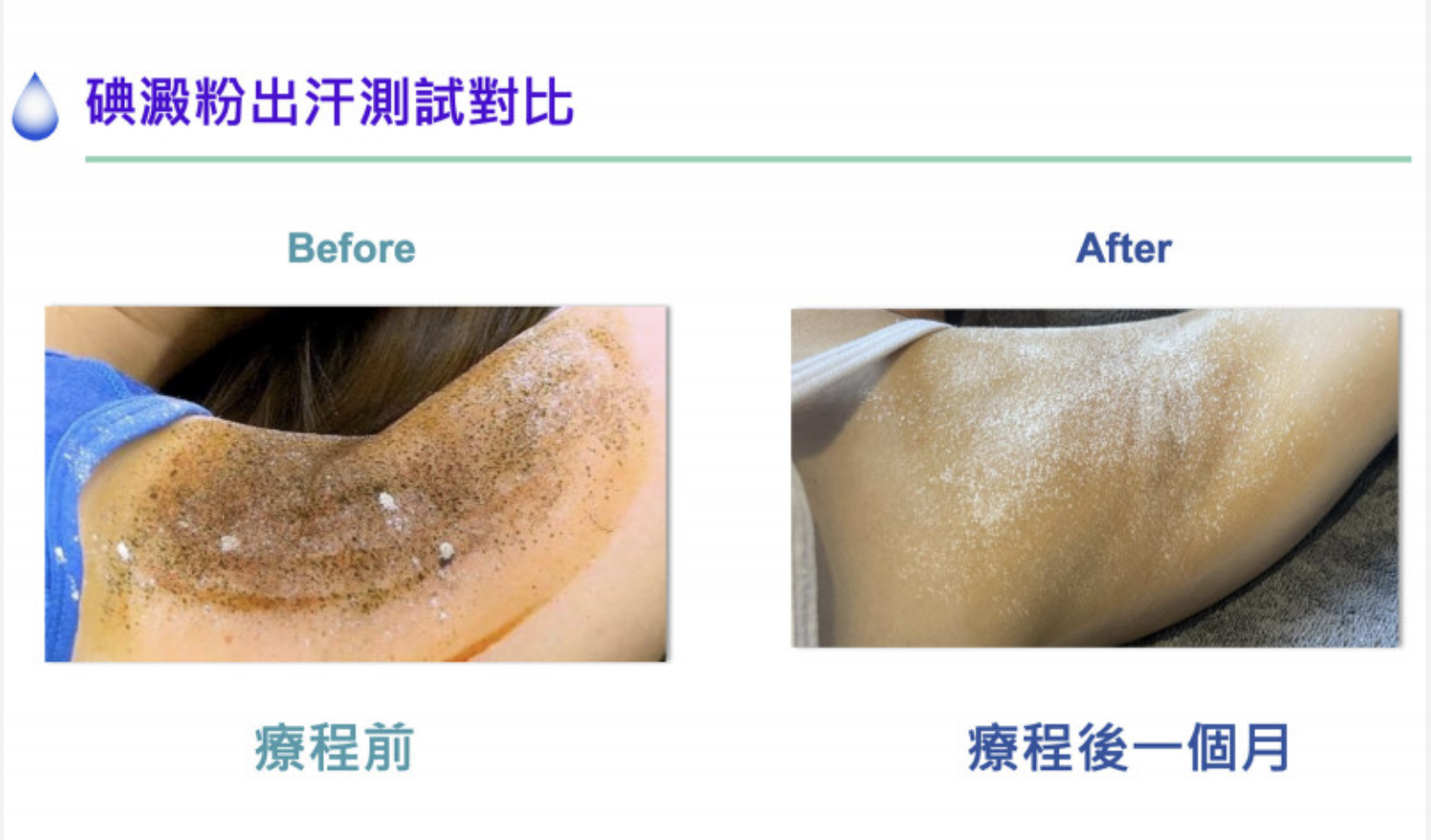 無須動刀可解「腋」味 臨床追蹤證實有效